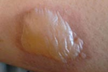 Hoang mang con bị nốt phỏng bất thường