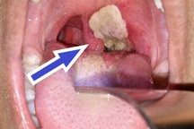 Bạch hầu dễ bị nhầm thành viêm họng: Phân biệt 2 bệnh này như thế nào?