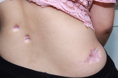 Bé gái bị tai biến sẹo xấu sau tiêm xoá sẹo tại thẩm mỹ viện