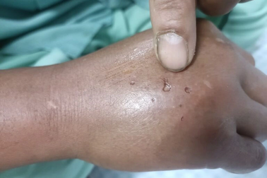 Hà Nội: Tìm chìa khóa, người đàn ông bị rắn trốn trong tủ cắn suýt hoại tử