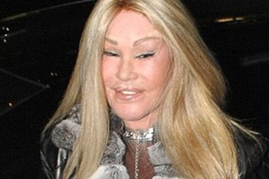 Khiếp sợ với gương mặt của "thảm họa" phẫu thuật thẩm mỹ