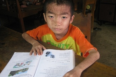 Cảm phục cậu bé mắc bệnh lạ, học giỏi