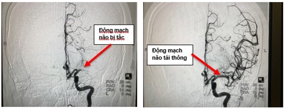 Cấp tốc vượt 150km đường biển và đường bộ kịp “giờ vàng” cấp cứu bệnh nhân đột quỵ - 1 Cấp tốc vượt 150km đường biển và đường bộ kịp “giờ vàng” cấp cứu bệnh nhân đột quỵ - 1