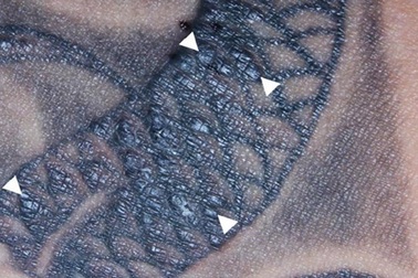 Mất thính giác và bị viêm mắt sau khi xăm hình