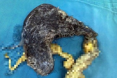 Bé trai 5 tuổi mắc chứng bệnh hiếm, ăn gần 0,5kg tóc