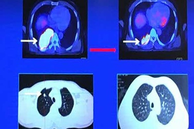 70% ca ung thư phổi phát hiện ở giai đoạn muộn
