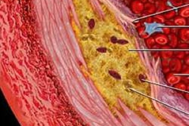 Nồng độ hoóc môn tuyến giáp có thể xác định được chứng xơ vữa động mạch