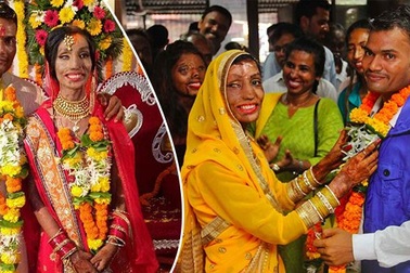 Mặt biến dạng vì axit, cô gái tìm thấy tình yêu nhờ cuộc gọi định mệnh