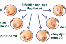 Những thực phẩm giúp ngăn ngừa ung thư vú