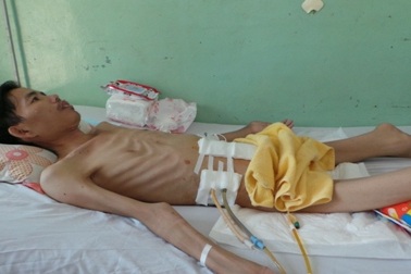 Cắt hơn 1m ruột hoại tử, cứu bệnh nhân da bọc xương