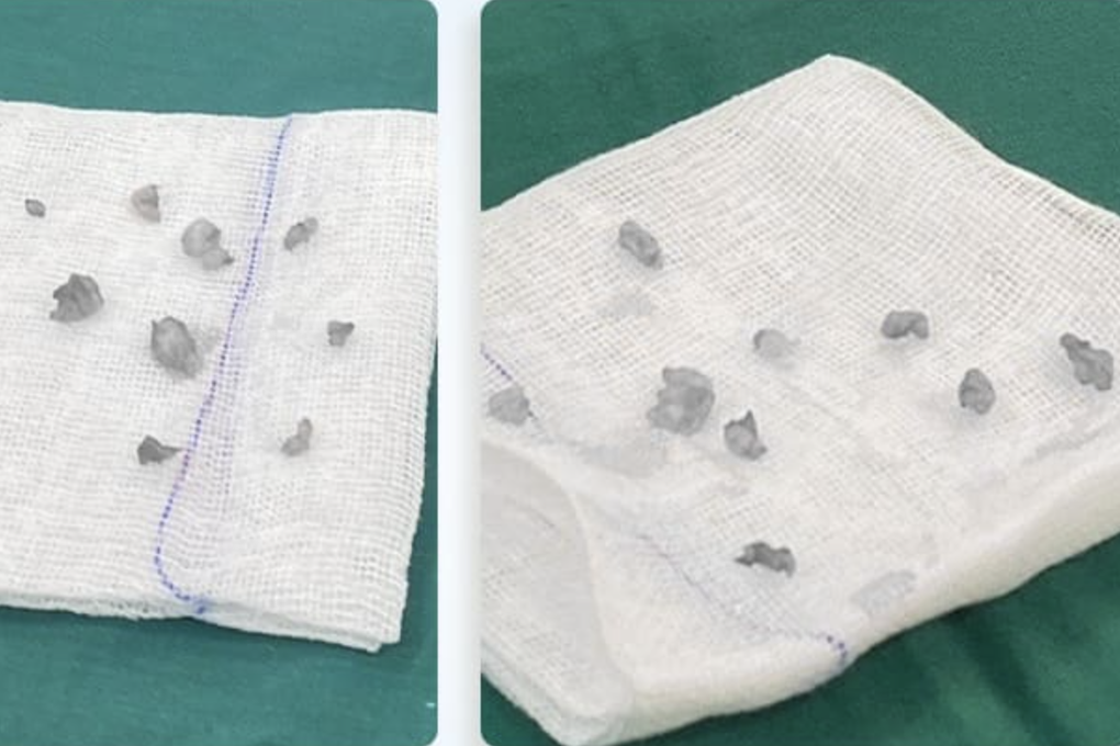 Mẹ 2 con bỗng sưng to và đau nhói nhũ hoa 3 tháng, suy sụp vì tưởng ung thư - 2 Mẹ 2 con bỗng sưng to và đau nhói nhũ hoa 3 tháng, suy sụp vì tưởng ung thư - 2