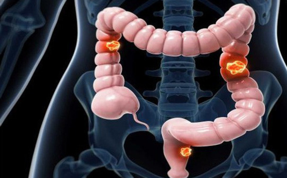 Ung thư đại trực tràng liệu có di truyền? - 1 Ung thư đại trực tràng liệu có di truyền? - 1