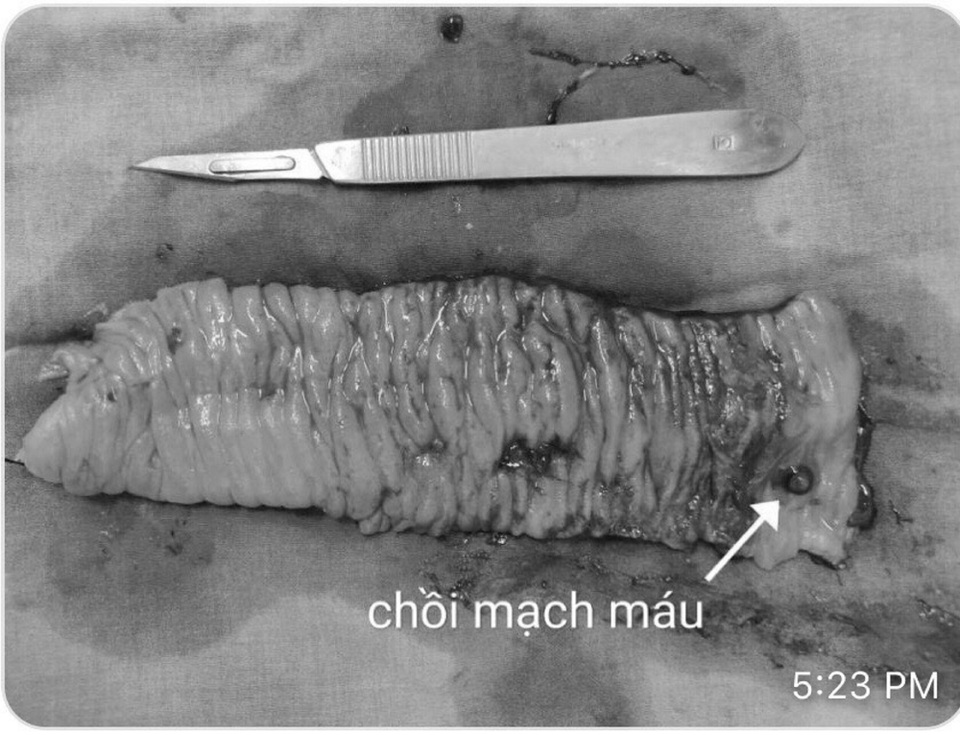 Nam bệnh nhân suýt “khô máu” vì nguyên nhân hiếm gặp - 2 Nam bệnh nhân suýt “khô máu” vì nguyên nhân hiếm gặp - 2