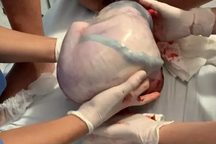 Cực hiếm: Một bé trong cặp sinh đôi còn nguyên trong túi ối