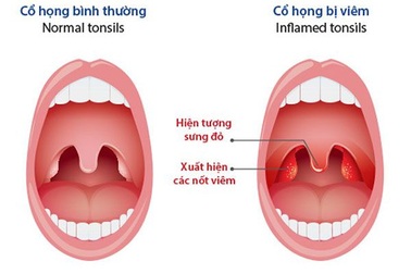 Giải pháp hỗ trợ hiệu quả cho người mắc viêm họng mãn tính