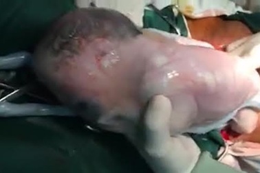 Khoảnh khắc cả 3 em bé còn nguyên trong bọc ối chui ra từ bụng mẹ