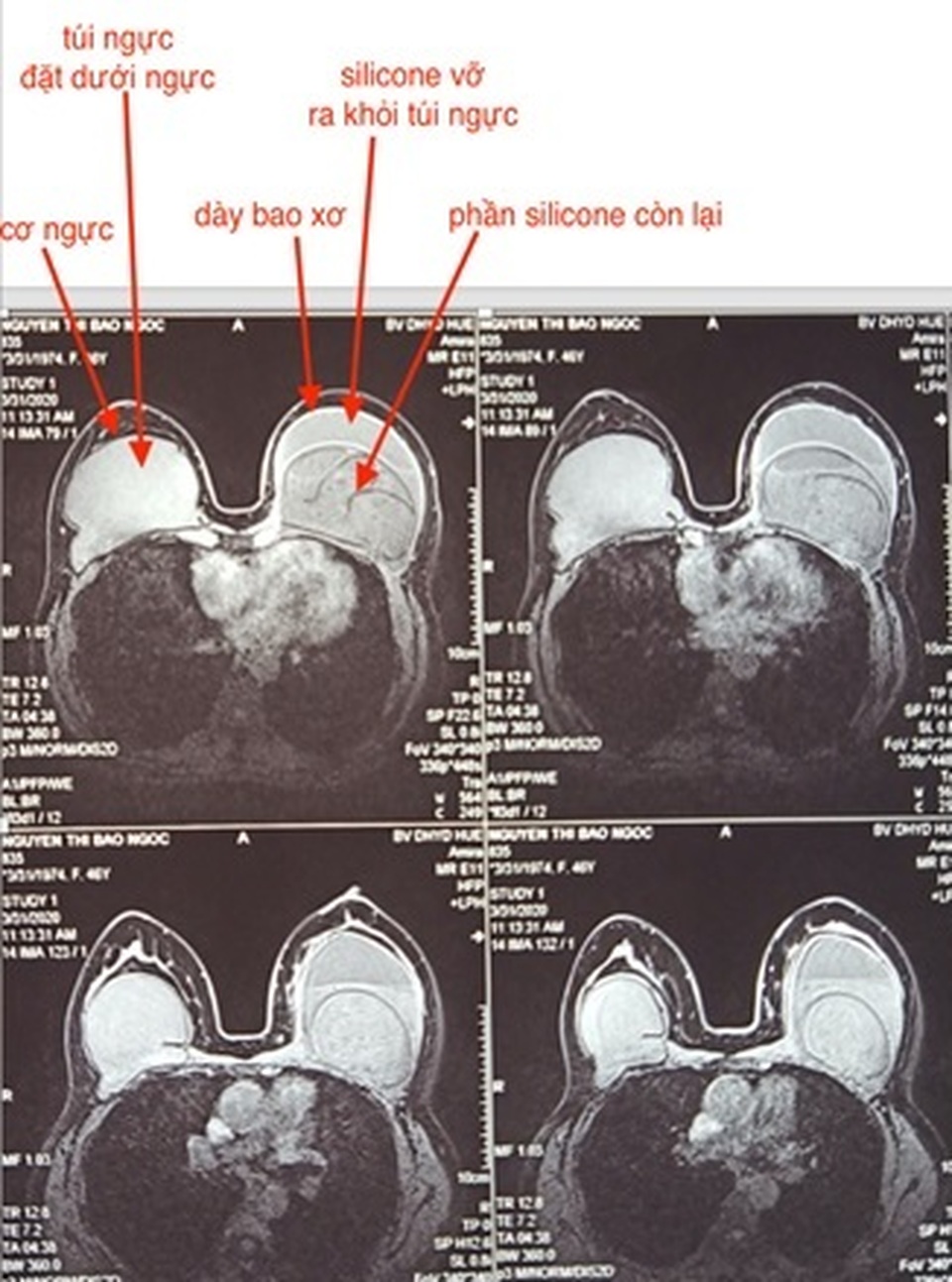 Nữ bệnh nhân bị vỡ túi ngực không triệu chứng sau 10 năm - 1 Nữ bệnh nhân bị vỡ túi ngực không triệu chứng sau 10 năm - 1