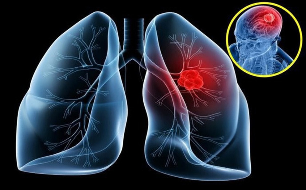 Ung thư phổi giai đoạn 3: Dấu hiệu nhận biết và tiên lượng của bệnh - 1 Ung thư phổi giai đoạn 3: Dấu hiệu nhận biết và tiên lượng của bệnh - 1