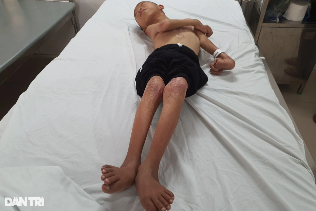 Nghẹn đắng trước cơ thể biến dạng khủng khiếp do bỏng của bé trai 14 tuổi - 1 Nghẹn đắng trước cơ thể biến dạng khủng khiếp do bỏng của bé trai 14 tuổi - 1