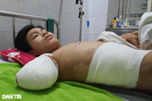 Bác sĩ kêu gọi giúp đỡ cậu bé 15 tuổi người Dao bị bỏng điện, mất tay phải