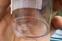 Người đàn ông nguy kịch vì nuốt xương cá từ miệng xuống tới bàng quang