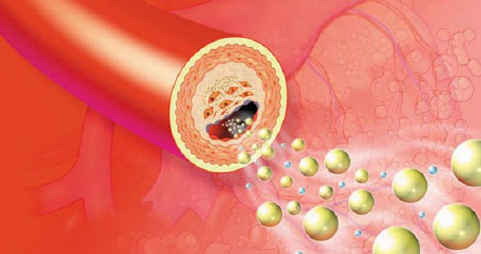 Lipidcleanz - Giải pháp giúp hỗ trợ kiểm soát rối loạn lipid máu - 1 Lipidcleanz - Giải pháp giúp hỗ trợ kiểm soát rối loạn lipid máu - 1