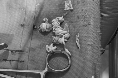 Suýt mất mạng vì hóc xương gà