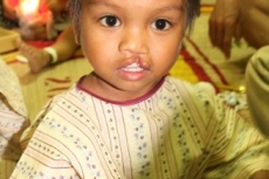 Phẫu thuật miễn phí 100 ca sứt môi, hở hàm ếch