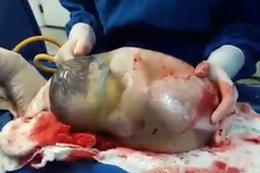 Hy hữu em bé chào đời vẫn nằm nguyên trong túi ối