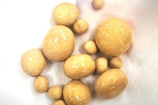 ការដកថ្ម ១៥ ដុំចេញពីប្លោកនោមបុរស - ១ Lấy 15 viên sỏi trong bàng quang người đàn ông - 1