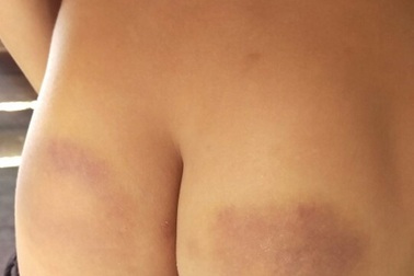 Cô giáo chủ nhiệm đánh bầm mông 12 học sinh do không hoàn thành bài tập