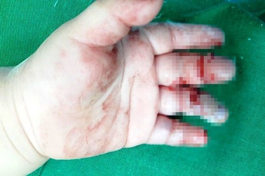 Cháu bé 16 tháng tuổi bị máy xay thịt nghiền dập nát bàn tay