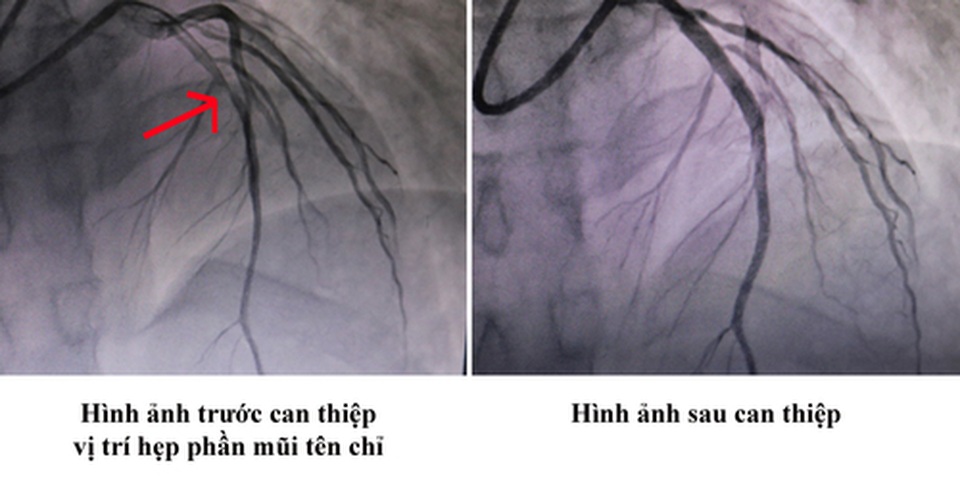 Đang khỏe mạnh, chàng trai 31 tuổi bỗng dưng bị nhồi máu cơ tim - 1 Đang khỏe mạnh, chàng trai 31 tuổi bỗng dưng bị nhồi máu cơ tim - 1