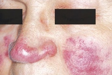 Biến chứng nguy hiểm từ lupus ban đỏ