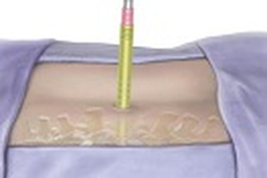 3 cách phẫu thuật cột sống ít xâm lấn