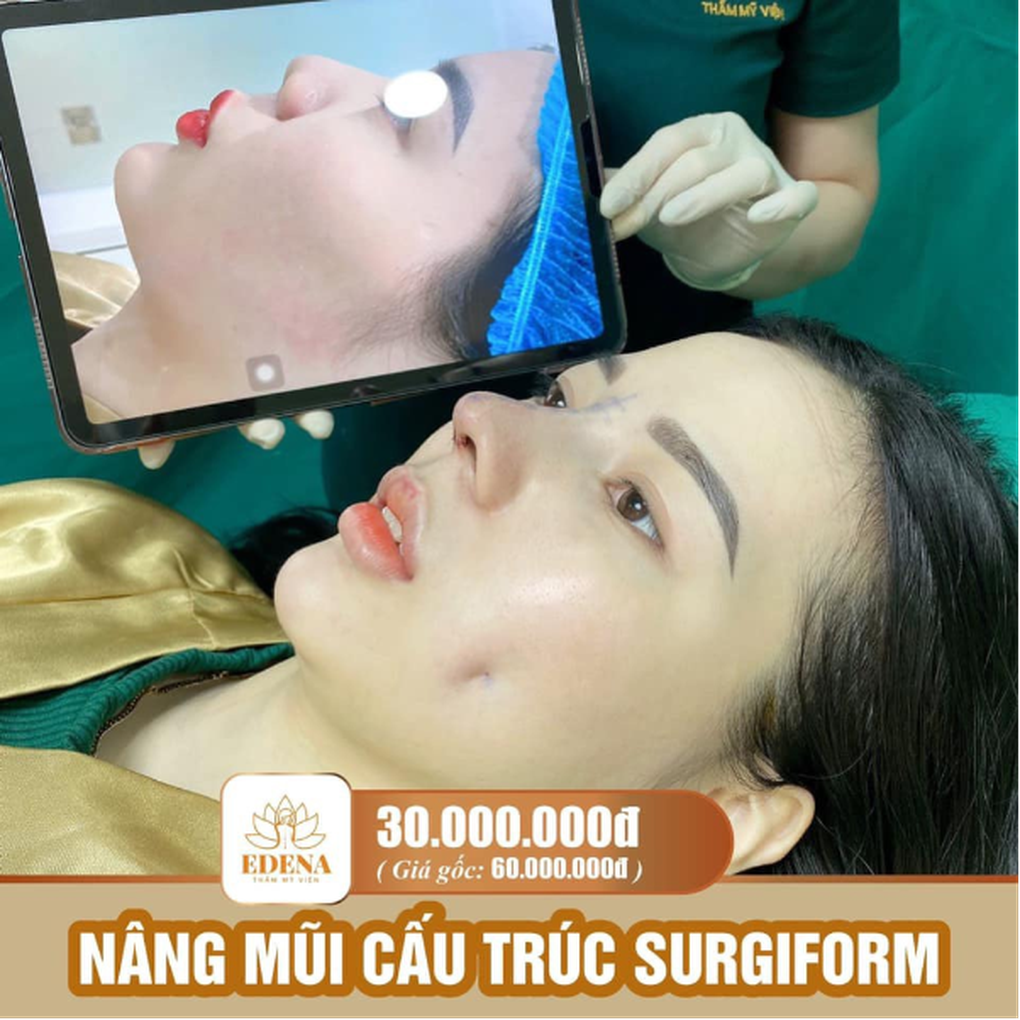 Nâng mũi cấu trúc với phương pháp mới từ Edena - 3 Nâng mũi cấu trúc với phương pháp mới từ Edena - 3