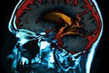 Hút thuốc, tiểu đường và béo phì có thể gây teo não