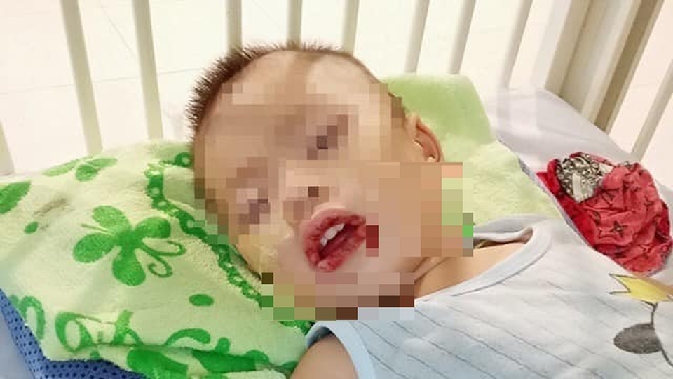 Bé trai 21 tháng tuổi loét thực quản, dạ dày vì uống nhầm chất tẩy bồn cầu - 1 Bé trai 21 tháng tuổi loét thực quản, dạ dày vì uống nhầm chất tẩy bồn cầu - 1