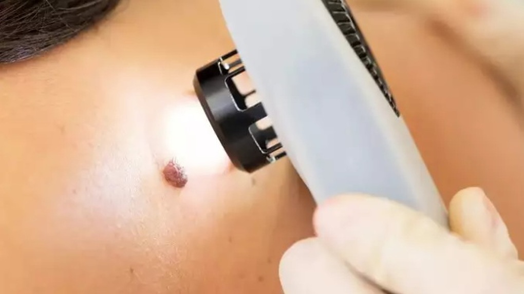 Vùng nào trên cơ thể dễ bị ung thư da nhất? - 1 Vùng nào trên cơ thể dễ bị ung thư da nhất? - 1