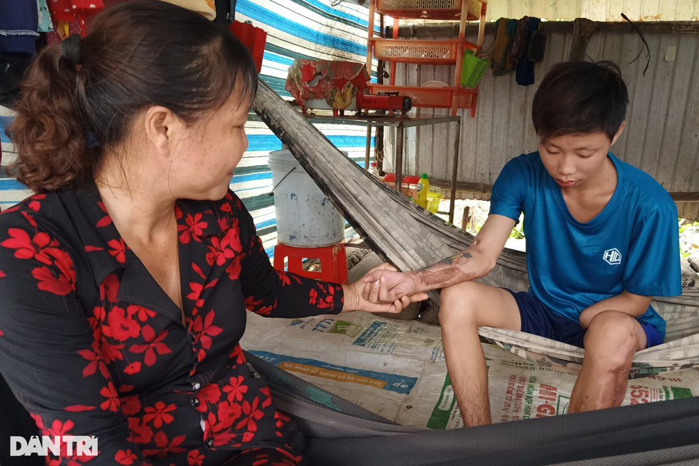 Bị tai nạn, chàng trai hiếu thảo mong có tiền lắp tay giả, phụ mẹ nuôi em - 5 Bị tai nạn, chàng trai hiếu thảo mong có tiền lắp tay giả, phụ mẹ nuôi em - 5