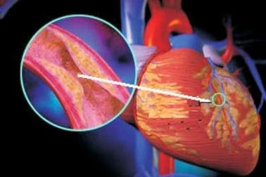 Rượu và béo phì - Thủ phạm gây đột tử do tim