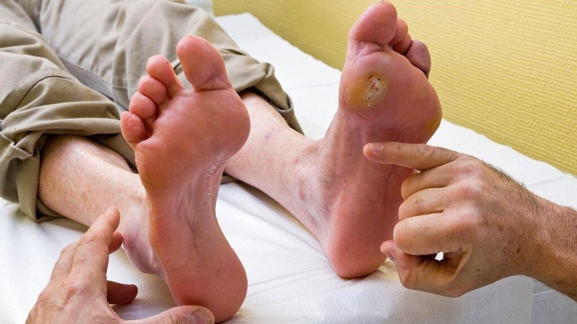 Biến chứng tiểu đường ở chân - làm sao để hạn chế? - 1 Biến chứng tiểu đường ở chân - làm sao để hạn chế? - 1
