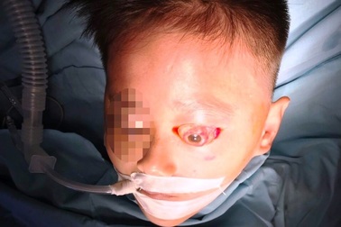 Bé trai bị đẩy lồi mắt ra ngoài sau tai nạn hy hữu