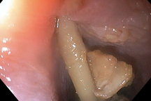 Thủng ruột suýt chết vì nuốt phải thứ không ngờ