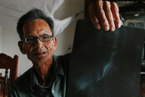 Người về từ “địa phủ” và 9 chiếc răng lưu lạc (*)