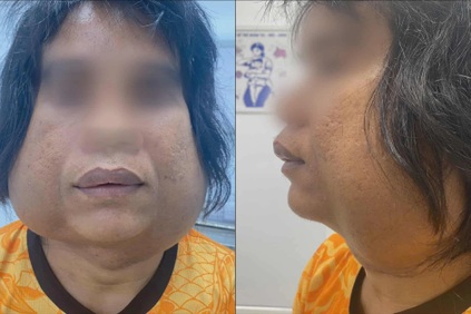 Chàng trai 10 năm mang 2 khối u "lạ", mổ xong lại mọc lên và phình to