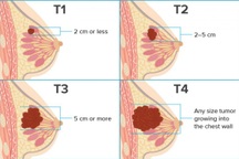 Các giai đoạn của ung thư vú