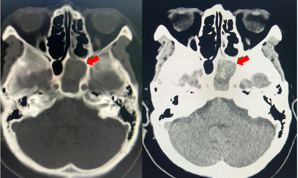 Durerea de cap semnalează o boală periculoasă care poate provoca orbire și leziuni cerebrale - 1 Cơn đau đầu báo hiệu căn bệnh nguy hiểm, có thể gây mù mắt, tồn thương não - 1