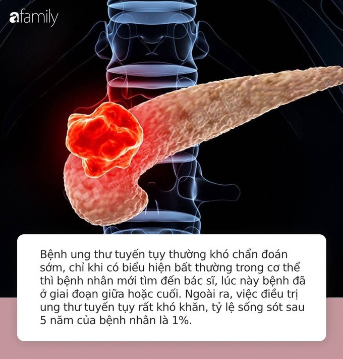 Từ chẩn đoán ung thư tuyến tụy đến tử vong chỉ trong vòng 1 năm: Hãy đi khám gấp nếu cơ thể có 4 điểm lạ này - Ảnh 1. Từ chẩn đoán ung thư tuyến tụy đến tử vong chỉ trong vòng 1 năm: Hãy đi khám gấp nếu cơ thể có 4 điểm lạ này - Ảnh 1.