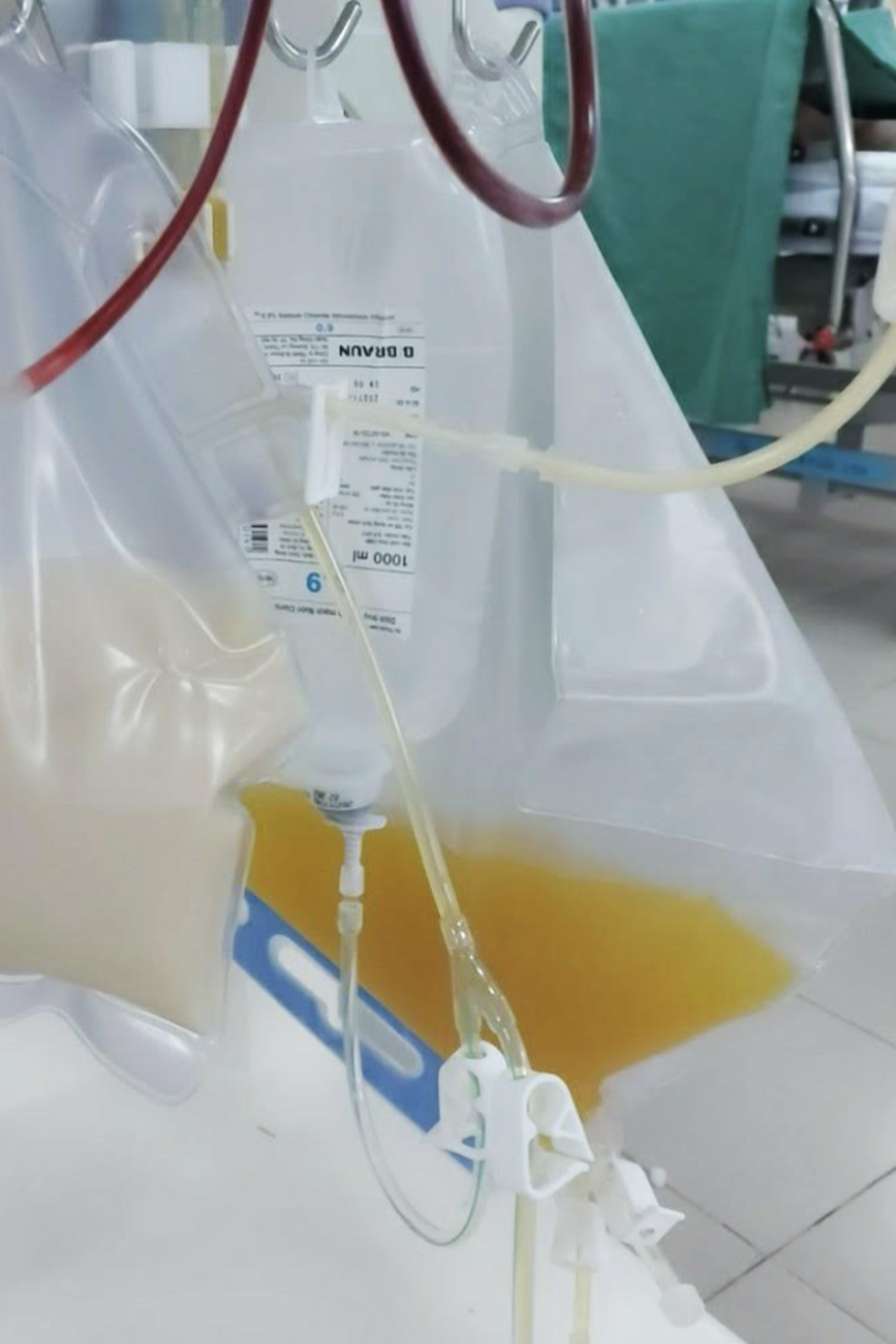 Ăn nhậu liên tục mừng… giỗ Tổ, nhiều người nhập viện cấp cứu tại TPHCM - 2 Ăn nhậu liên tục mừng… giỗ Tổ, nhiều người nhập viện cấp cứu tại TPHCM - 2